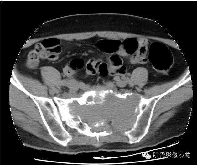 【病例】骶骨高分化浆细胞瘤一例CT病例讨论 【病例】骶骨高分化浆细胞瘤一例CT病例讨论