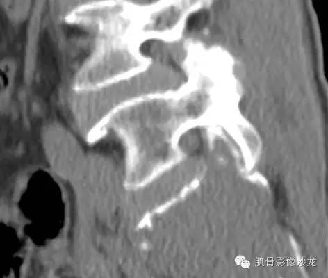 【病例】骶骨高分化浆细胞瘤一例CT病例讨论 【病例】骶骨高分化浆细胞瘤一例CT病例讨论