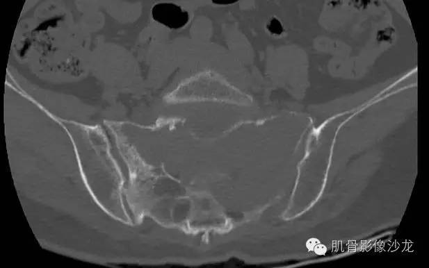 【病例】骶骨高分化浆细胞瘤一例CT病例讨论 【病例】骶骨高分化浆细胞瘤一例CT病例讨论