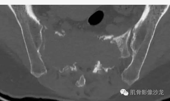 【病例】骶骨高分化浆细胞瘤一例CT病例讨论 【病例】骶骨高分化浆细胞瘤一例CT病例讨论