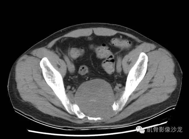 【病例】骶骨脊索瘤一例CT病例讨论