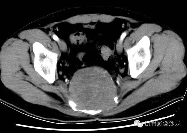 【病例】骶骨脊索瘤一例CT病例讨论