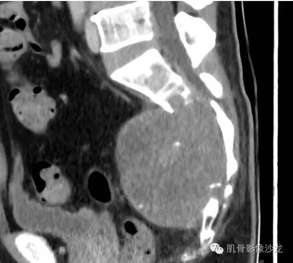 【病例】骶骨脊索瘤一例CT病例讨论