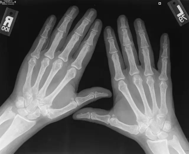 【病例】双手痛风性关节炎1例X线影像表现