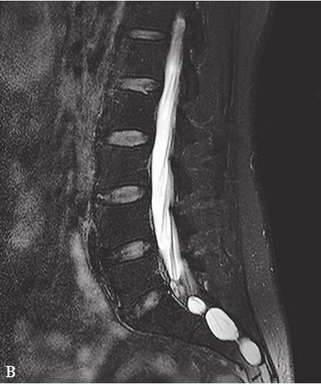 【病例】骶管Tarlov囊肿1例MR影像表现