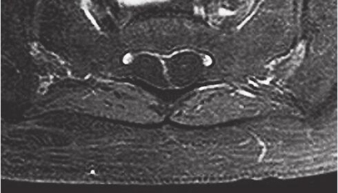 【病例】骶管Tarlov囊肿1例MR影像表现