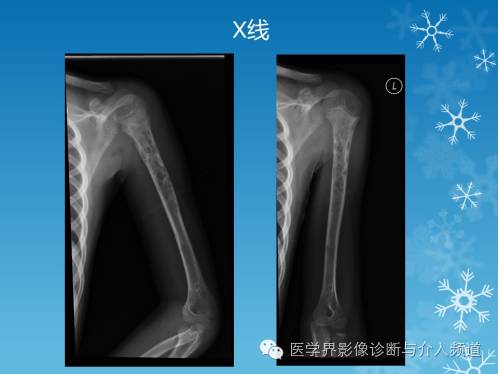 【病例】肱骨血管瘤1例X线MR影像表现