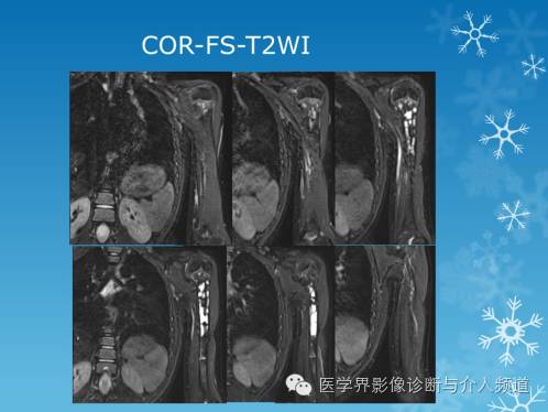 【病例】肱骨血管瘤1例X线MR影像表现