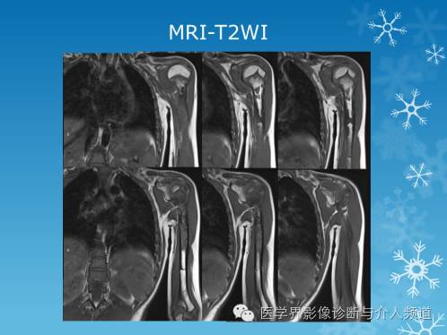 【病例】肱骨血管瘤1例X线MR影像表现