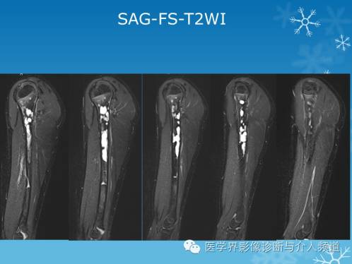 【病例】肱骨血管瘤1例X线MR影像表现