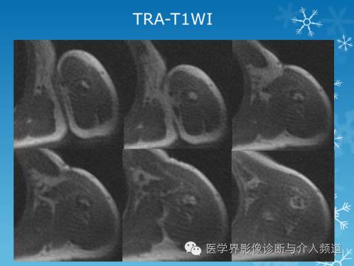【病例】肱骨血管瘤1例X线MR影像表现