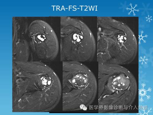 【病例】肱骨血管瘤1例X线MR影像表现