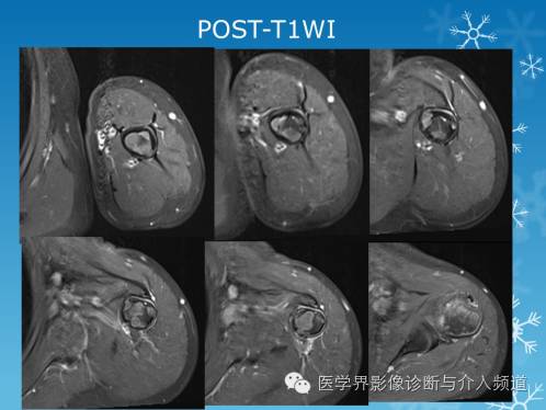 【病例】肱骨血管瘤1例X线MR影像表现