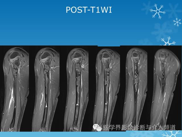【病例】肱骨血管瘤1例X线MR影像表现