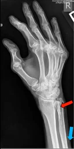 【病例】万里挑一的混合型结缔组织病1例X线