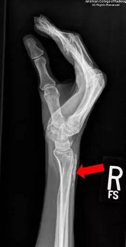 【病例】万里挑一的混合型结缔组织病1例X线