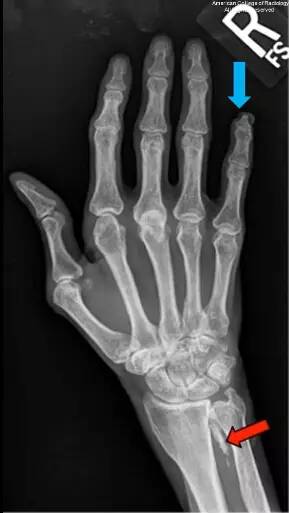 【病例】万里挑一的混合型结缔组织病1例X线