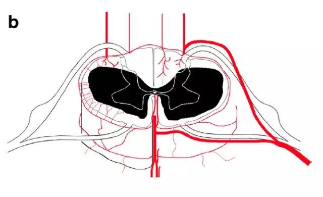 脊髓缺血综合征影像学评估