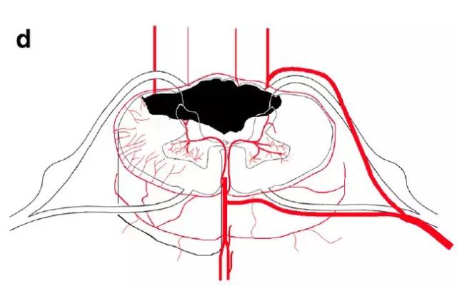 脊髓缺血综合征影像学评估