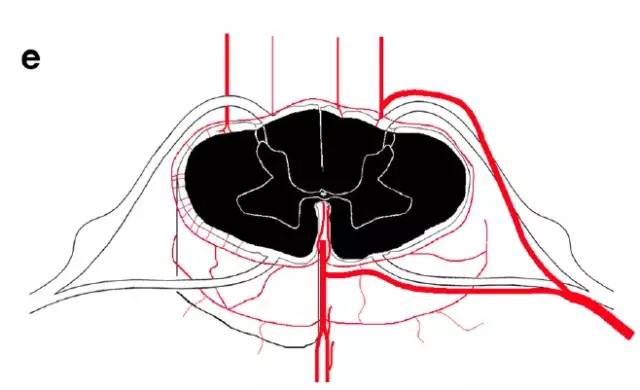 脊髓缺血综合征影像学评估