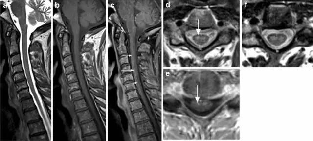 脊髓缺血综合征影像学评估