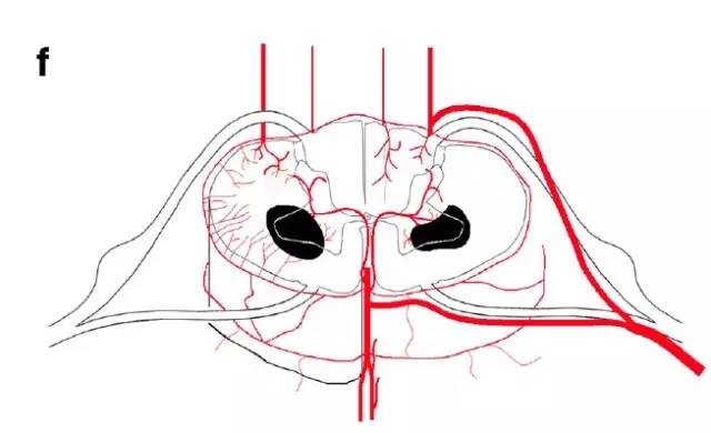 脊髓缺血综合征影像学评估