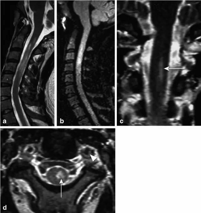 脊髓缺血综合征影像学评估