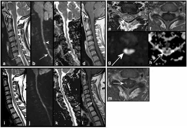 脊髓缺血综合征影像学评估