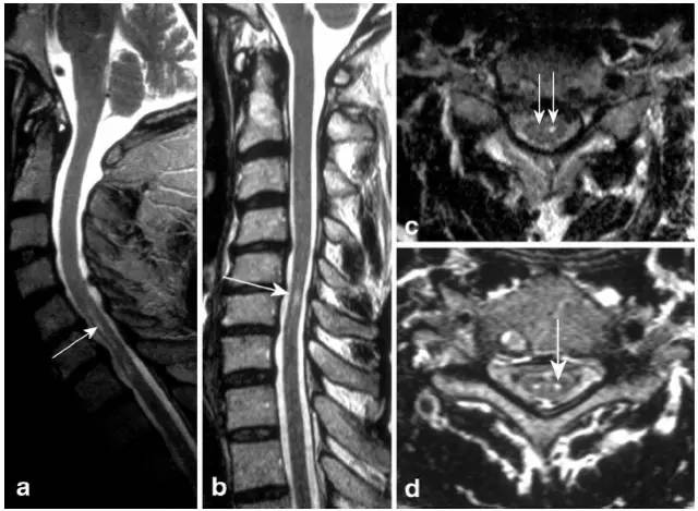 脊髓缺血综合征影像学评估
