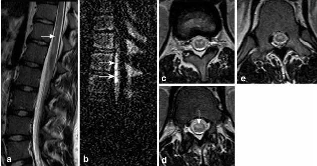 脊髓缺血综合征影像学评估