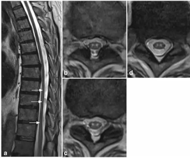 脊髓缺血综合征影像学评估