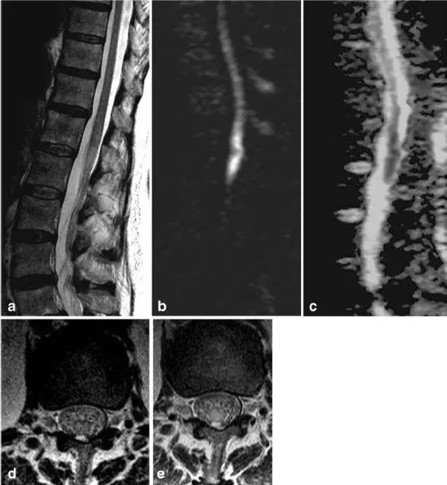 脊髓缺血综合征影像学评估