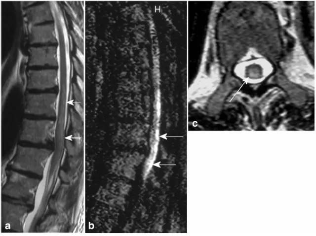 脊髓缺血综合征影像学评估