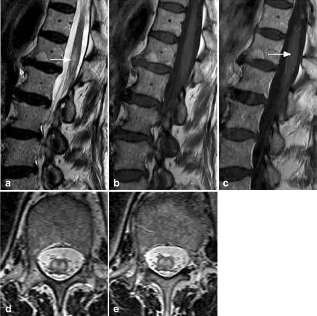脊髓缺血综合征影像学评估