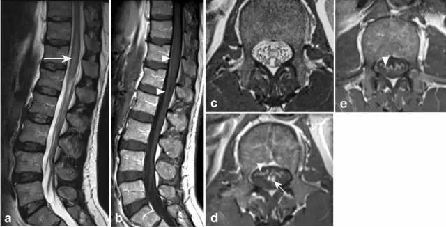 脊髓缺血综合征影像学评估