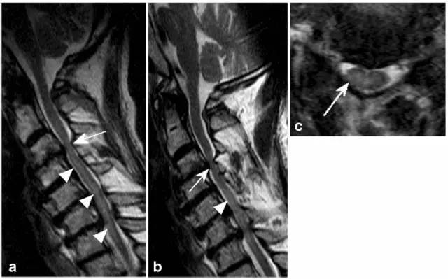 脊髓缺血综合征影像学评估