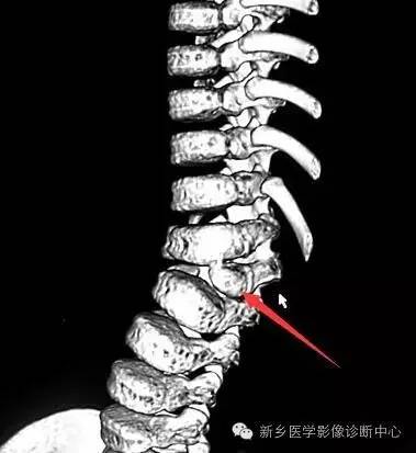 脊椎椎体畸形（半椎体、蝴蝶椎）