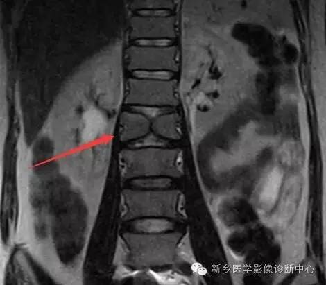 脊椎椎体畸形（半椎体、蝴蝶椎）