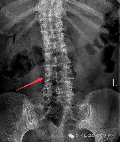 脊椎椎体畸形（半椎体、蝴蝶椎）