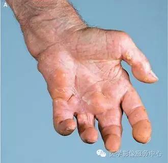 【病例】系统性硬化1例