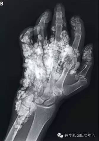 【病例】系统性硬化1例