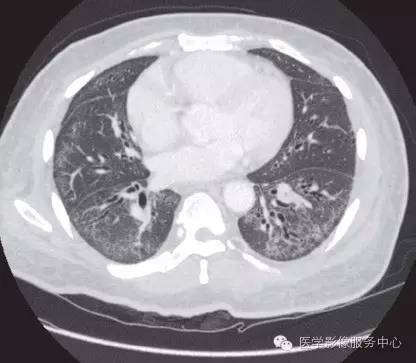 【病例】系统性硬化1例
