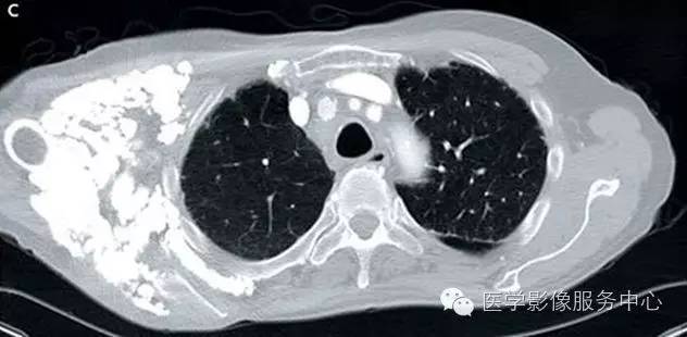 【病例】系统性硬化1例