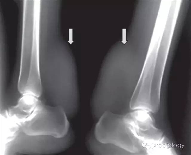 跟腱黄色瘤 Achilles tendon xanthoma