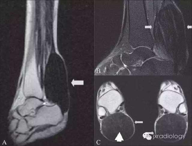 跟腱黄色瘤 Achilles tendon xanthoma