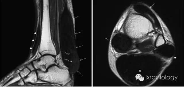 跟腱黄色瘤 Achilles tendon xanthoma