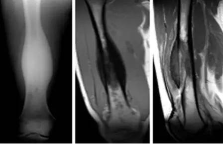 【病例】慢性骨髓炎1例X线及MR