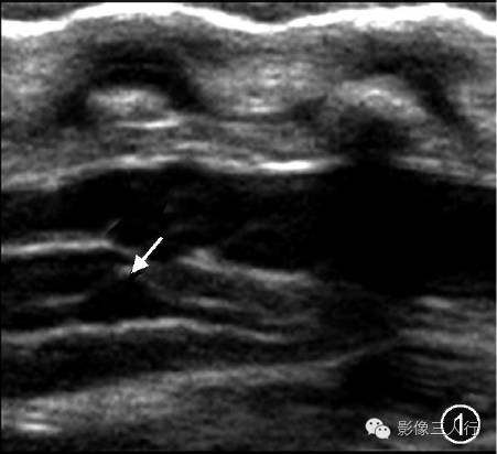重新正确认识第五脑室的概念及其影像表现