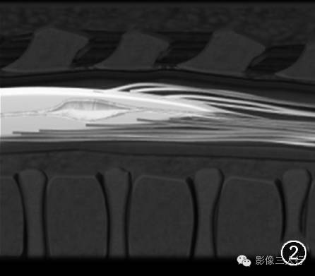 重新正确认识第五脑室的概念及其影像表现