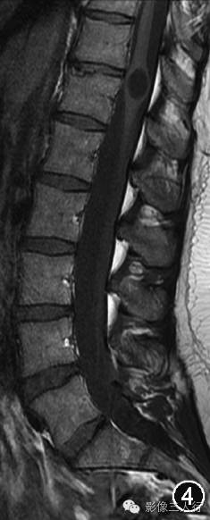 重新正确认识第五脑室的概念及其影像表现